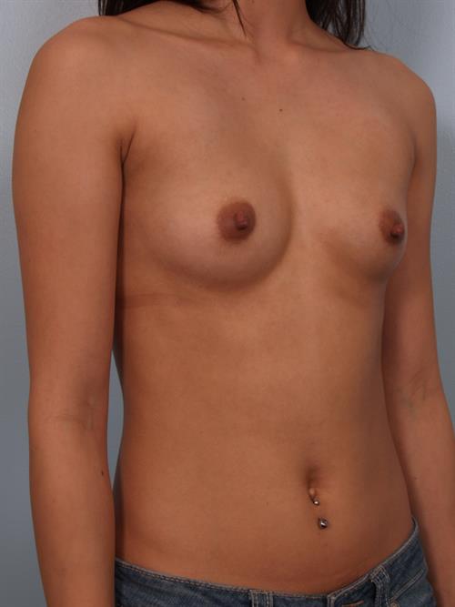 Breast Augmentation Before Photo | Phoenix and Scottsdale, AZ | Scottsdale Center for Plastic Surgery