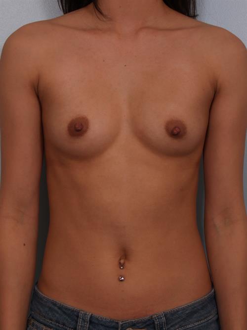 Breast Augmentation Before Photo | Phoenix and Scottsdale, AZ | Scottsdale Center for Plastic Surgery