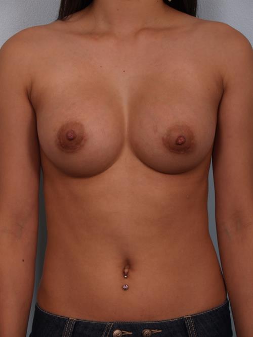 Breast Augmentation After Photo | Phoenix and Scottsdale, AZ | Scottsdale Center for Plastic Surgery