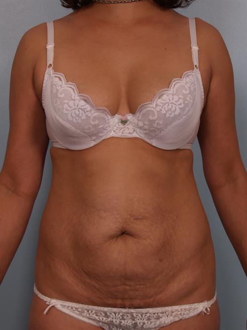 Tummy Tuck Before Photo | Phoenix and Scottsdale, AZ | Scottsdale Center for Plastic Surgery