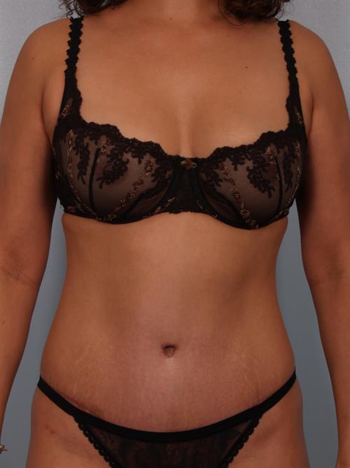 Tummy Tuck After Photo | Phoenix and Scottsdale, AZ | Scottsdale Center for Plastic Surgery