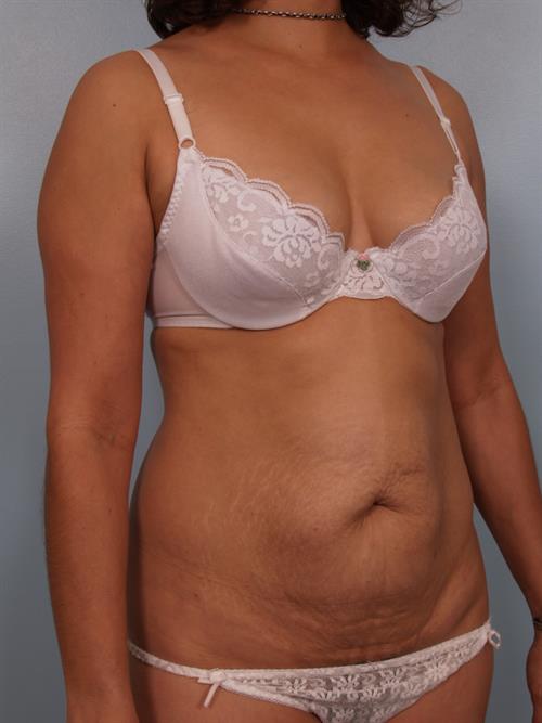 Tummy Tuck Before Photo | Phoenix and Scottsdale, AZ | Scottsdale Center for Plastic Surgery