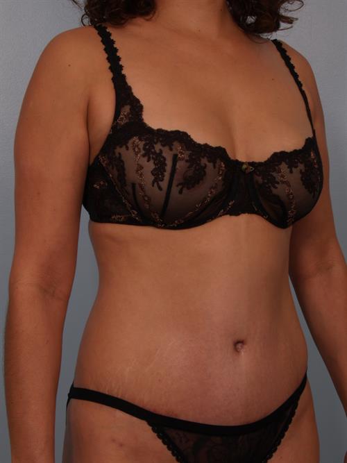 Tummy Tuck After Photo | Phoenix and Scottsdale, AZ | Scottsdale Center for Plastic Surgery
