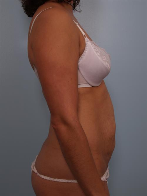 Tummy Tuck Before Photo | Phoenix and Scottsdale, AZ | Scottsdale Center for Plastic Surgery