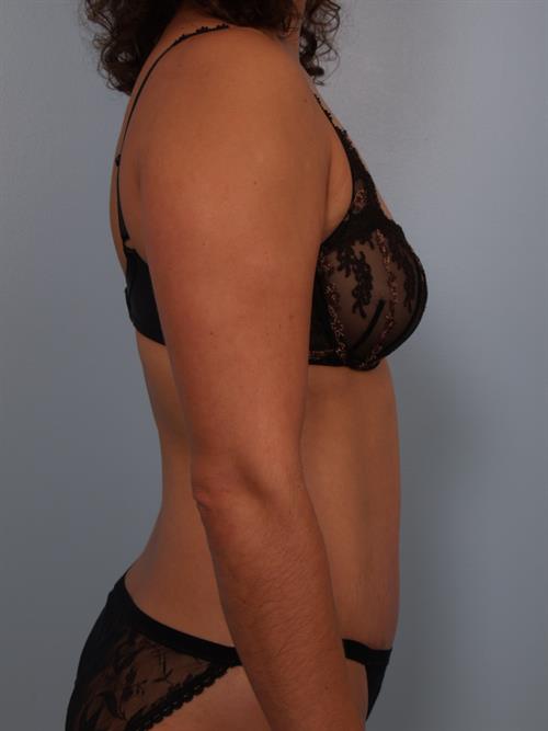 Tummy Tuck After Photo | Phoenix and Scottsdale, AZ | Scottsdale Center for Plastic Surgery