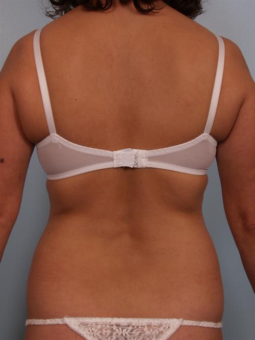 Tummy Tuck Before Photo | Phoenix and Scottsdale, AZ | Scottsdale Center for Plastic Surgery