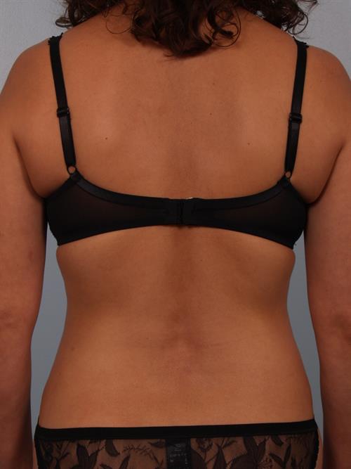 Tummy Tuck After Photo | Phoenix and Scottsdale, AZ | Scottsdale Center for Plastic Surgery