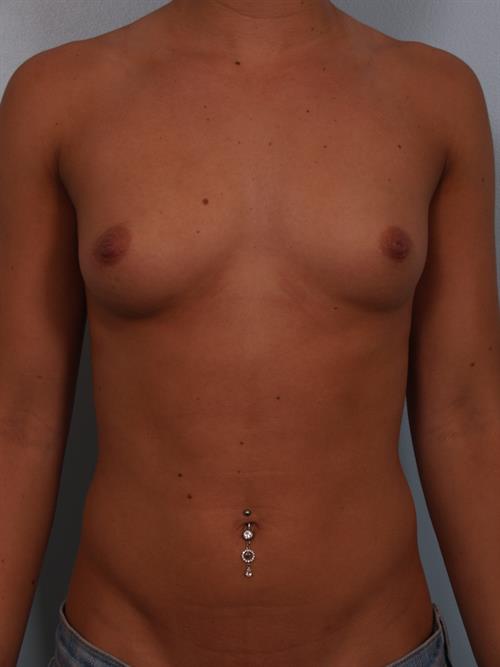 Breast Augmentation Before Photo | Phoenix and Scottsdale, AZ | Scottsdale Center for Plastic Surgery