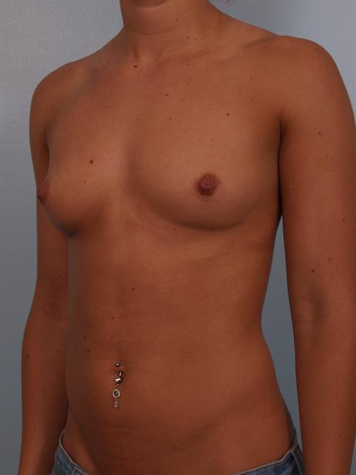 Breast Augmentation Before Photo | Phoenix and Scottsdale, AZ | Scottsdale Center for Plastic Surgery