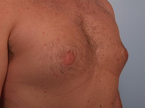 Male Breast/Areola Reduction Before Photo | Phoenix and Scottsdale, AZ | Scottsdale Center for Plastic Surgery