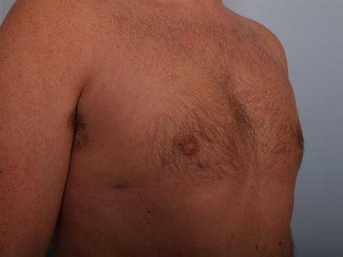 Male Breast/Areola Reduction After Photo | Phoenix and Scottsdale, AZ | Scottsdale Center for Plastic Surgery