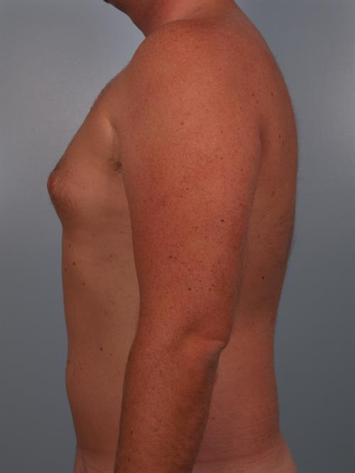 Male Breast/Areola Reduction Before Photo | Phoenix and Scottsdale, AZ | Scottsdale Center for Plastic Surgery