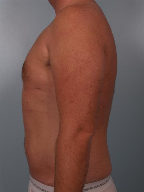 Male Breast/Areola Reduction After Photo | Phoenix and Scottsdale, AZ | Scottsdale Center for Plastic Surgery