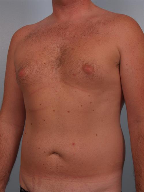 Male Breast/Areola Reduction Before Photo | Phoenix and Scottsdale, AZ | Scottsdale Center for Plastic Surgery