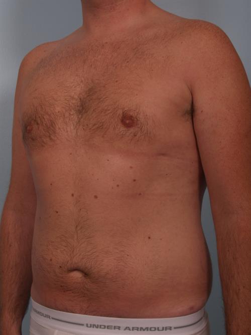 Male Breast/Areola Reduction After Photo | Phoenix and Scottsdale, AZ | Scottsdale Center for Plastic Surgery