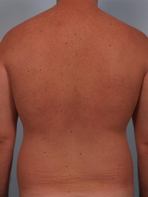 Male Breast/Areola Reduction Before Photo | Phoenix and Scottsdale, AZ | Scottsdale Center for Plastic Surgery