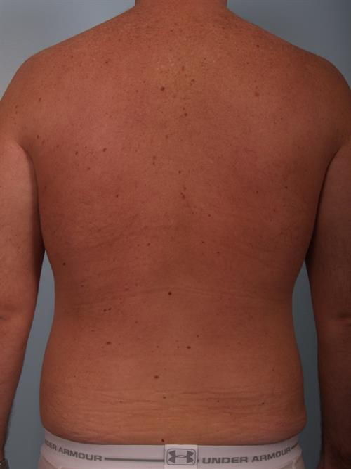 Male Breast/Areola Reduction After Photo | Phoenix and Scottsdale, AZ | Scottsdale Center for Plastic Surgery
