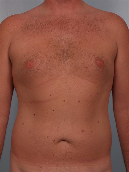 Male Breast/Areola Reduction Before Photo | Phoenix and Scottsdale, AZ | Scottsdale Center for Plastic Surgery