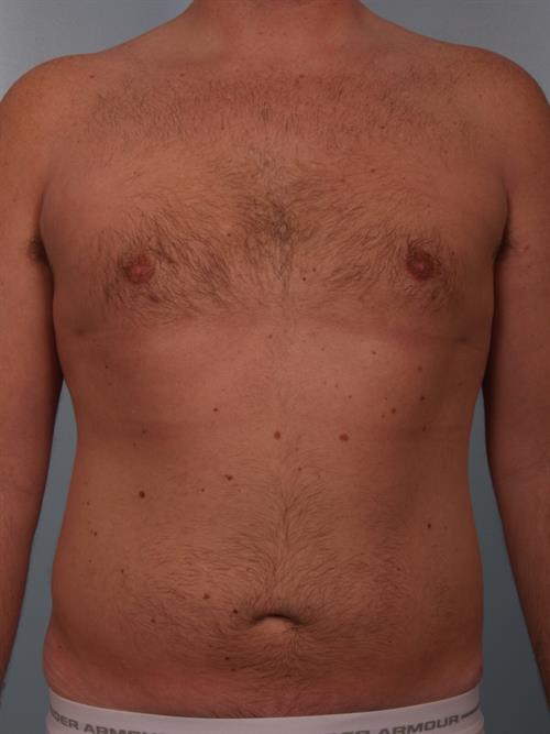 Male Breast/Areola Reduction After Photo | Phoenix and Scottsdale, AZ | Scottsdale Center for Plastic Surgery