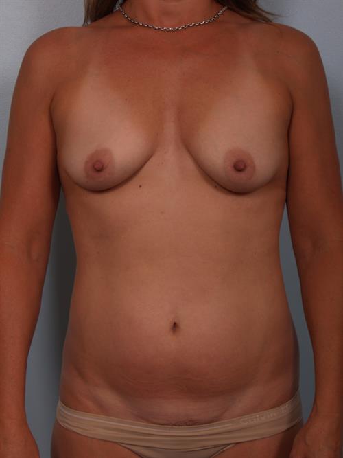 Power Assisted Liposuction Before Photo | Phoenix and Scottsdale, AZ | Scottsdale Center for Plastic Surgery
