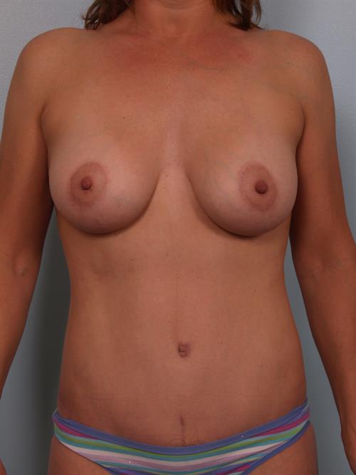 Power Assisted Liposuction After Photo | Phoenix and Scottsdale, AZ | Scottsdale Center for Plastic Surgery