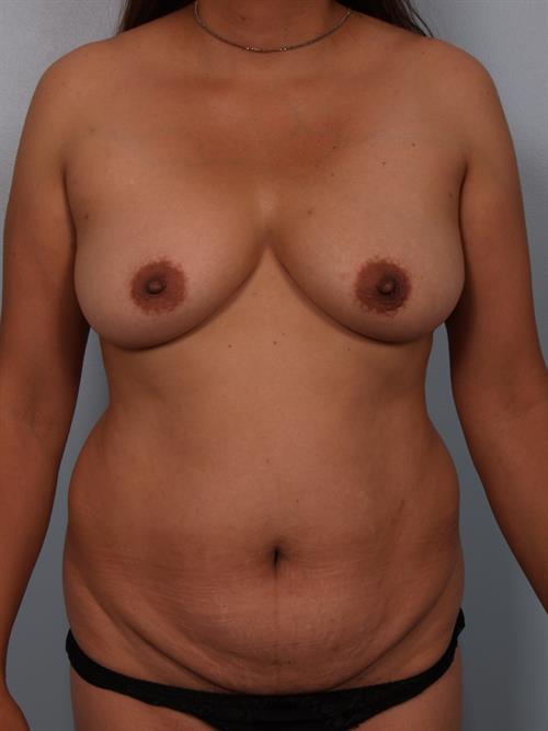 Tummy Tuck Before Photo | Phoenix and Scottsdale, AZ | Scottsdale Center for Plastic Surgery