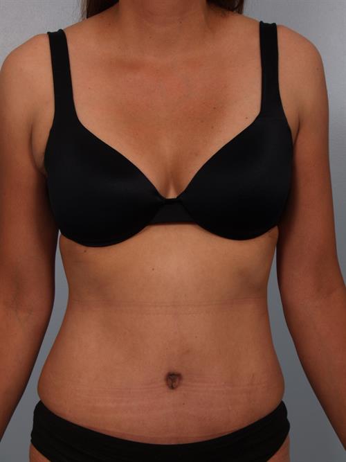 Tummy Tuck After Photo | Phoenix and Scottsdale, AZ | Scottsdale Center for Plastic Surgery