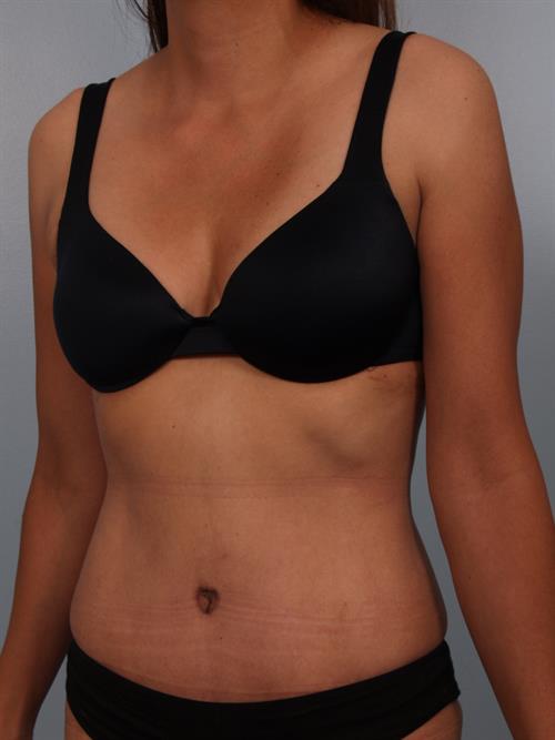 Tummy Tuck After Photo | Phoenix and Scottsdale, AZ | Scottsdale Center for Plastic Surgery