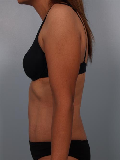 Tummy Tuck After Photo | Phoenix and Scottsdale, AZ | Scottsdale Center for Plastic Surgery
