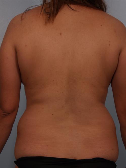 Tummy Tuck Before Photo | Phoenix and Scottsdale, AZ | Scottsdale Center for Plastic Surgery