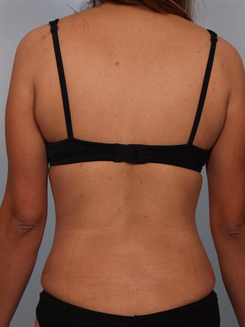 Tummy Tuck After Photo | Phoenix and Scottsdale, AZ | Scottsdale Center for Plastic Surgery