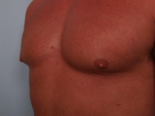 Male Breast/Areola Reduction Before Photo | ,  | 