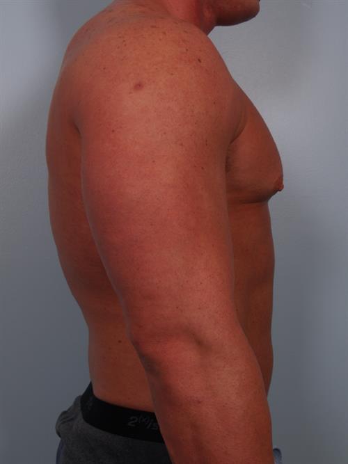 Male Breast/Areola Reduction Before Photo | Phoenix and Scottsdale, AZ | Scottsdale Center for Plastic Surgery