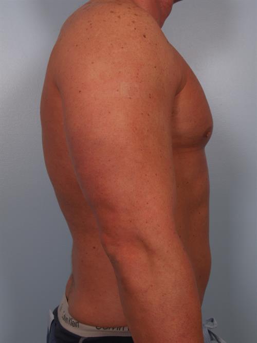 Male Breast/Areola Reduction After Photo | Phoenix and Scottsdale, AZ | Scottsdale Center for Plastic Surgery