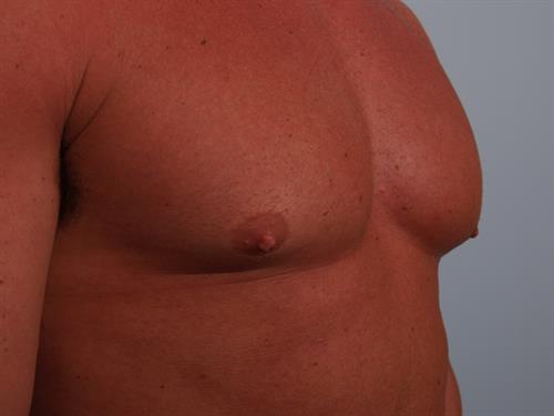 Male Breast/Areola Reduction Before Photo | ,  | 