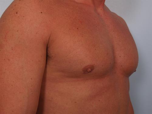 Male Breast/Areola Reduction After Photo | Phoenix and Scottsdale, AZ | Scottsdale Center for Plastic Surgery
