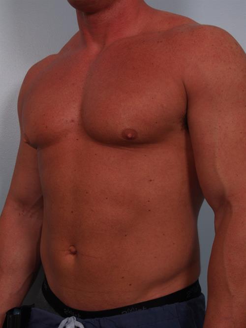 Male Breast/Areola Reduction Before Photo | Phoenix and Scottsdale, AZ | Scottsdale Center for Plastic Surgery