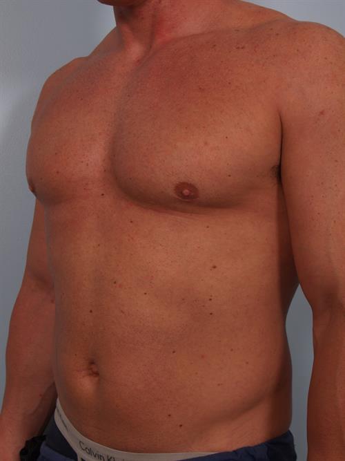 Male Breast/Areola Reduction After Photo | Phoenix and Scottsdale, AZ | Scottsdale Center for Plastic Surgery