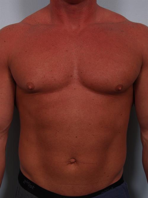 Male Breast/Areola Reduction Before Photo | Phoenix and Scottsdale, AZ | Scottsdale Center for Plastic Surgery