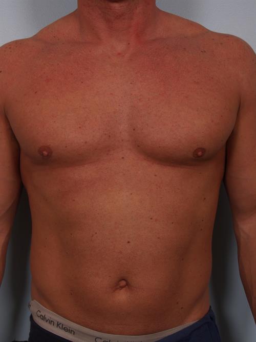 Male Breast/Areola Reduction After Photo | Phoenix and Scottsdale, AZ | Scottsdale Center for Plastic Surgery