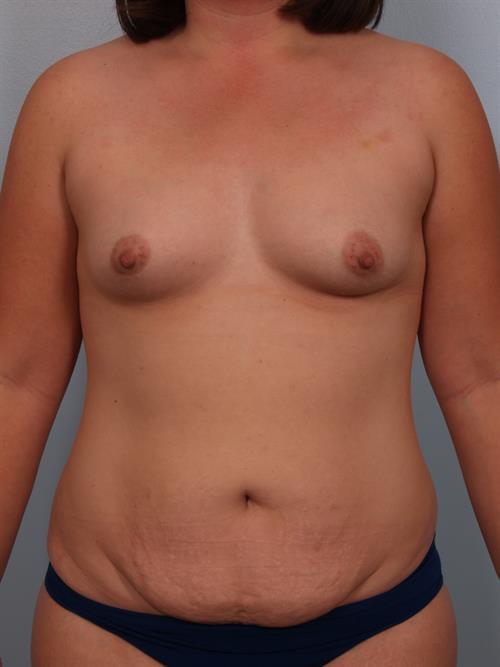 Breast Augmentation Before Photo | Phoenix and Scottsdale, AZ | Scottsdale Center for Plastic Surgery
