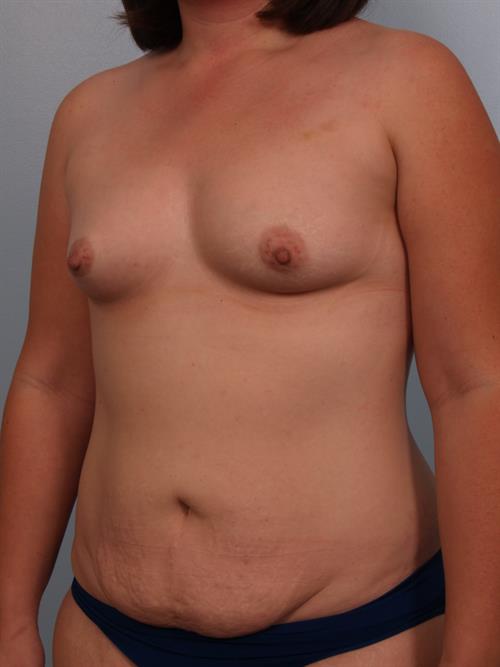Breast Augmentation Before Photo | Phoenix and Scottsdale, AZ | Scottsdale Center for Plastic Surgery