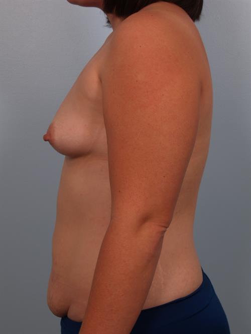 Breast Augmentation Before Photo | Phoenix and Scottsdale, AZ | Scottsdale Center for Plastic Surgery