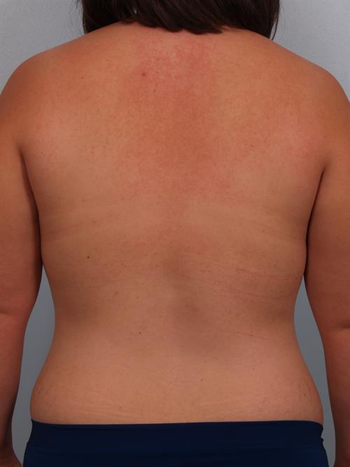 Breast Augmentation Before Photo | Phoenix and Scottsdale, AZ | Scottsdale Center for Plastic Surgery