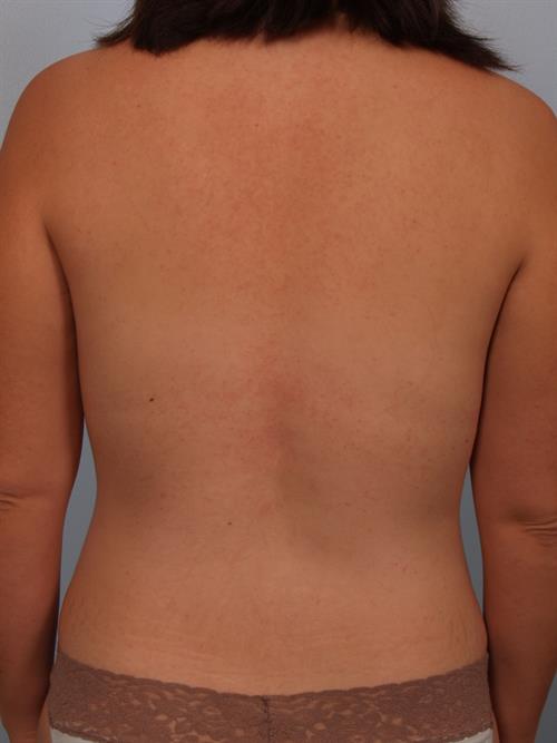 Breast Augmentation After Photo | Phoenix and Scottsdale, AZ | Scottsdale Center for Plastic Surgery