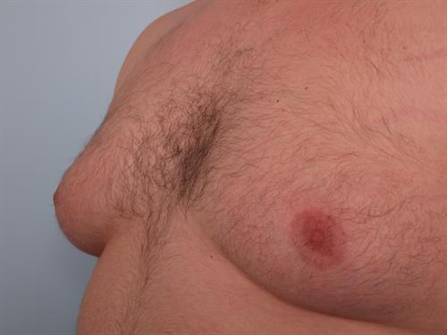 Male Breast/Areola Reduction Before Photo | Phoenix and Scottsdale, AZ | Scottsdale Center for Plastic Surgery