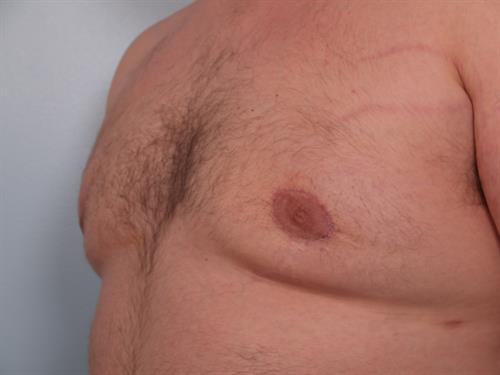 Male Breast/Areola Reduction After Photo | Phoenix and Scottsdale, AZ | Scottsdale Center for Plastic Surgery