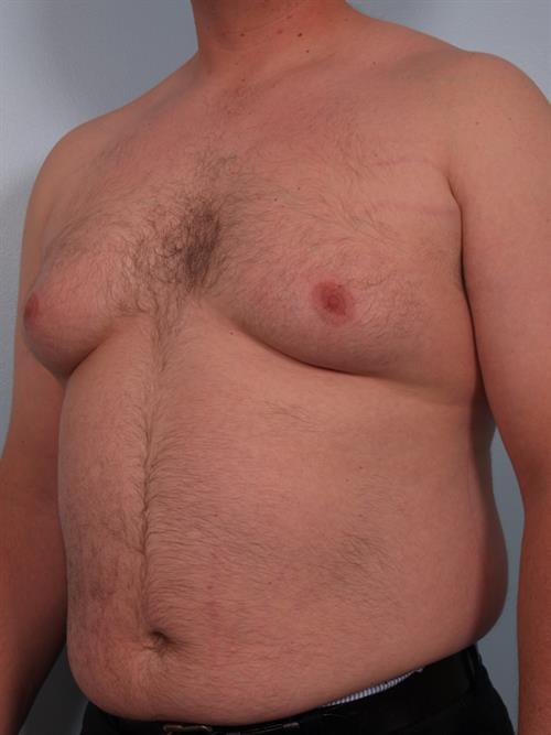 Male Breast/Areola Reduction Before Photo | Phoenix and Scottsdale, AZ | Scottsdale Center for Plastic Surgery