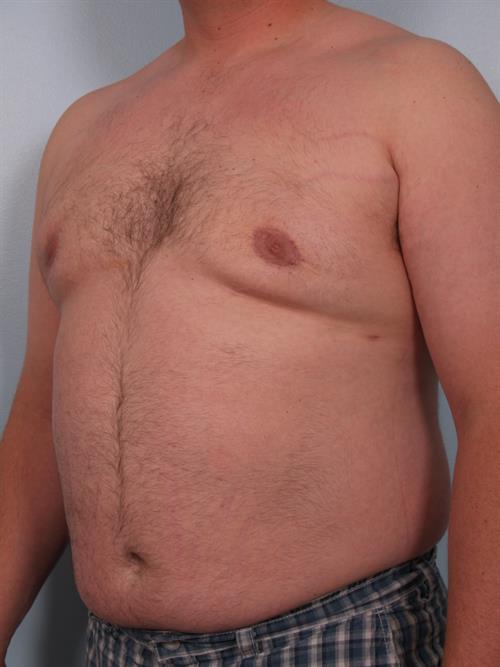 Male Breast/Areola Reduction After Photo | Phoenix and Scottsdale, AZ | Scottsdale Center for Plastic Surgery