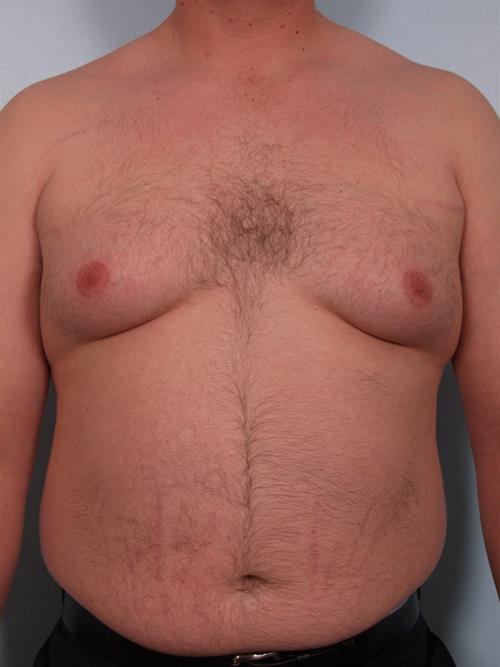 Male Breast/Areola Reduction Before Photo | Phoenix and Scottsdale, AZ | Scottsdale Center for Plastic Surgery